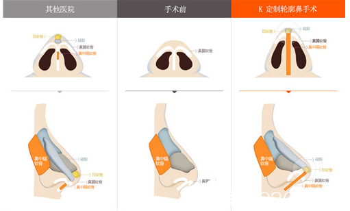 K整形醫(yī)院定制輪廓鼻整形 K整形醫(yī)院定制輪廓鼻整形