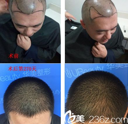合肥華美整形美容醫(yī)院官駒赳做頭發(fā)種植案例前后效果對比 合肥華美整形美容醫(yī)院官駒赳做頭發(fā)種植案例前后效果對比