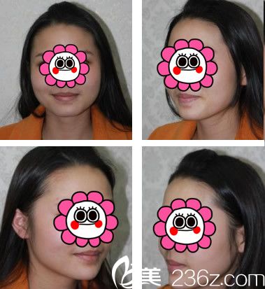 在合肥華美整形美容醫(yī)院找官駒赳做玻尿酸隆下巴案例 在合肥華美整形美容醫(yī)院找官駒赳做玻尿酸隆下巴案例