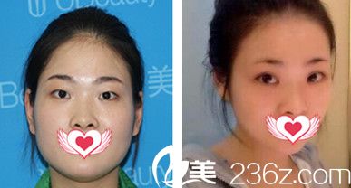合肥華美張先玲做雙眼皮整形怎么樣？看張先玲全切雙眼皮整形案例效果來證明