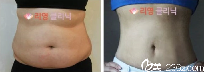 金光晏院長(zhǎng)腰腹部吸脂案例 金光晏院長(zhǎng)腰腹部吸脂案例