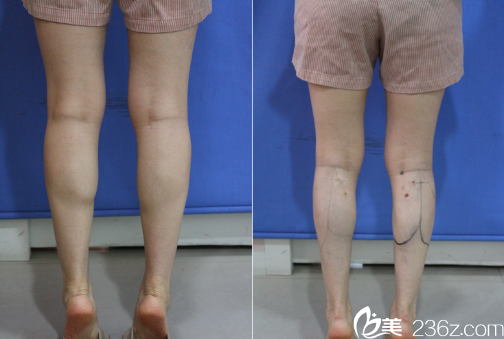 李俊宇院長小腿塑形案例