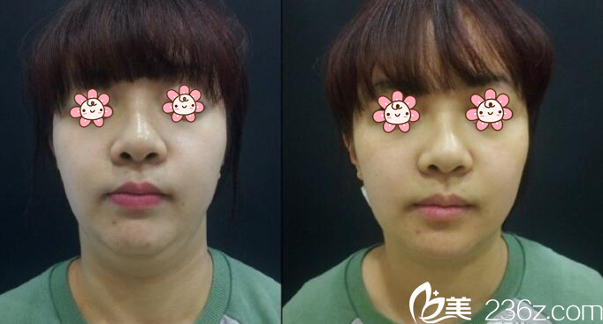 李俊宇院長面部吸脂案例