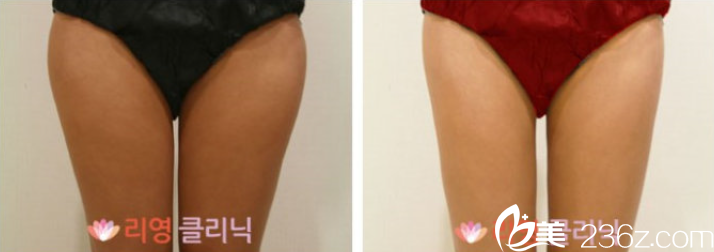 嚴(yán)日準(zhǔn)院長大腿吸脂案例