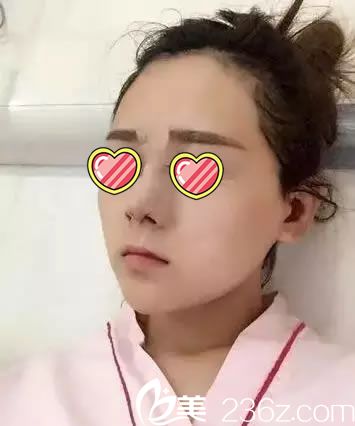 在杭州連天美做鼻綜合當(dāng)天照片