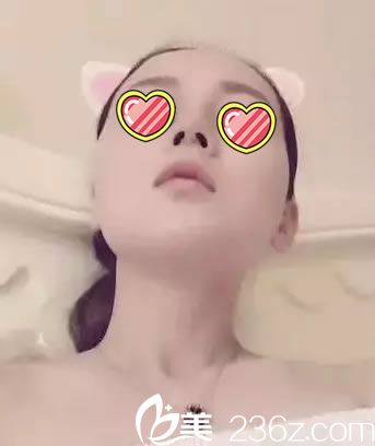 鼻綜合手術(shù)后昂頭看切口情況