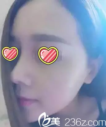 鼻綜合手術(shù)兩周鼻部特寫照片