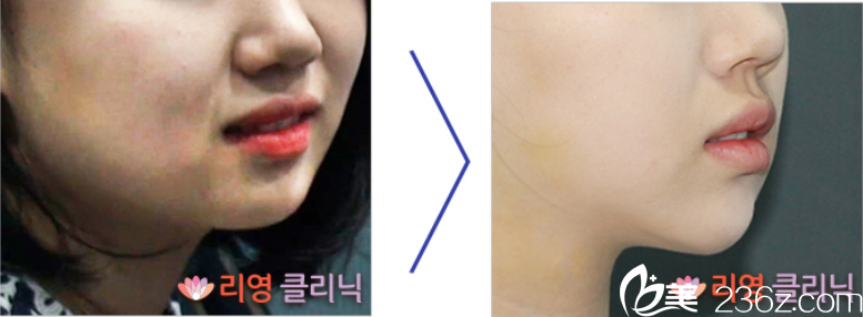 崔峻榮院長面部吸脂案例1