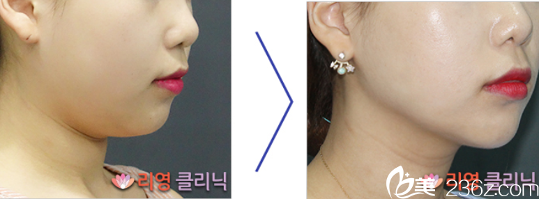 崔院長面部吸脂案例2