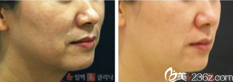 金美靜院長面部除皺案例