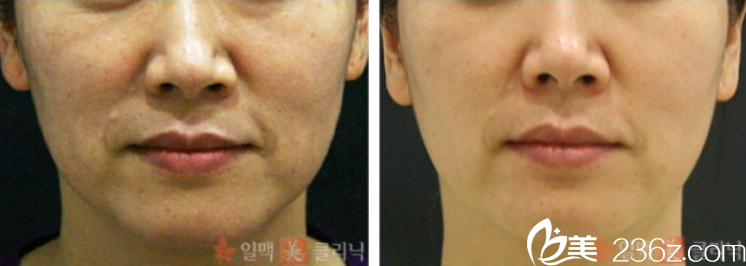 面部皺紋改善案例