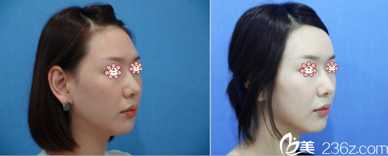 金基熏院長脂肪填充額頭案例 金基熏院長脂肪填充額頭案例