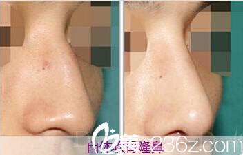 鼻整形前后效果展示 鼻整形前后效果展示