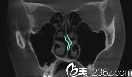 N Plus醫(yī)院鼻部CT檢測圖 N Plus醫(yī)院鼻部CT檢測圖