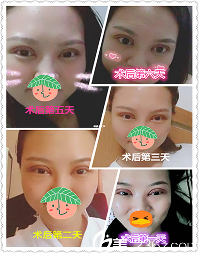 合肥華美整形美容醫(yī)院趙輯全切雙眼皮術(shù)后第1-6天恢復(fù)過程圖