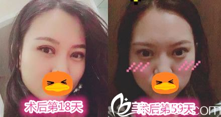 趙輯做雙眼皮手術(shù)后第18天和59天的效果圖