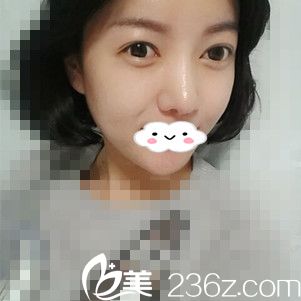 金在元院長給我做的糖果眼角 +鼻修復(fù)+全臉脂肪填充真的很贊