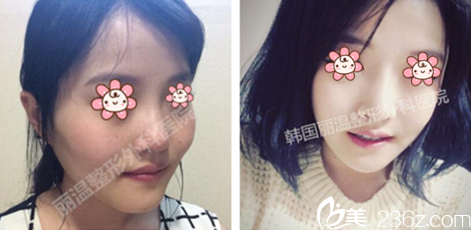 顴骨縮小案例 顴骨縮小案例