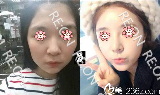 面部輪廓案例2 面部輪廓案例2