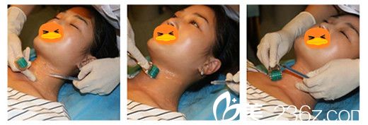 讓合肥華美整形美容醫(yī)院王榮堂主任給我做黃金微針去頸紋過(guò)程圖