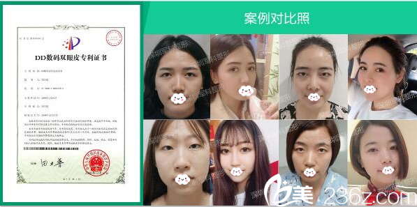 深圳軍科整形醫(yī)院劉月更雙眼皮案例 深圳軍科整形醫(yī)院劉月更雙眼皮案例