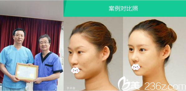 深圳軍科劉月更隆鼻案例 深圳軍科劉月更隆鼻案例