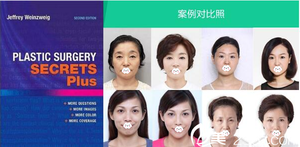 深圳軍科整形醫(yī)院劉月更面部除皺案例 深圳軍科整形醫(yī)院劉月更面部除皺案例