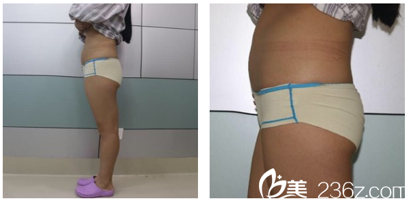 吸脂術(shù)前照片 吸脂術(shù)前照片