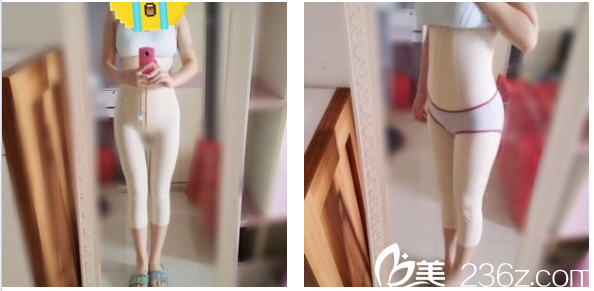 去深圳美萊做完抽脂第二天在家 去深圳美萊做完抽脂第二天在家