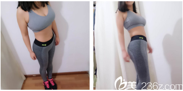 又去深圳美萊做了臀線提升4個月了 又去深圳美萊做了臀線提升4個月了