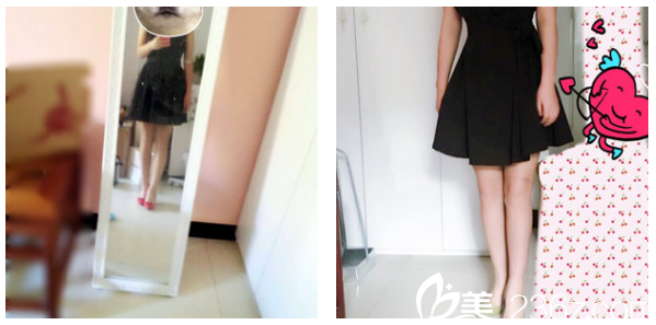 深圳美萊郭杰醫(yī)生腰腹部和大腿抽脂2個月自拍 深圳美萊郭杰醫(yī)生腰腹部和大腿抽脂2個月自拍