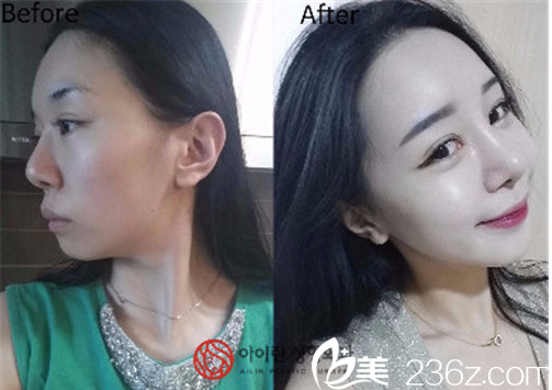 金院長鼻部整形案例 金院長鼻部整形案例