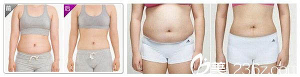 楊建華主任埋線減肥案例 楊建華主任埋線減肥案例