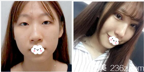 雙眼皮前后對比圖 雙眼皮前后對比圖