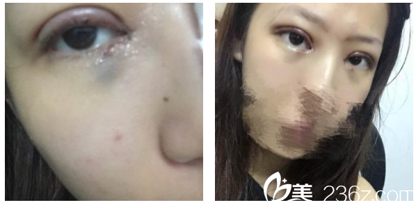 深圳軍科劉月更雙眼皮第5天 深圳軍科劉月更雙眼皮第5天