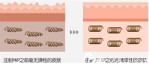 PRP自體脂肪移植