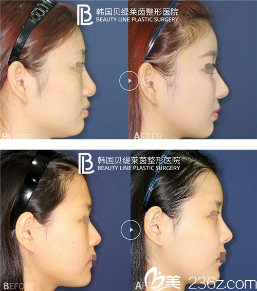 PRP自體脂肪移植真人案例