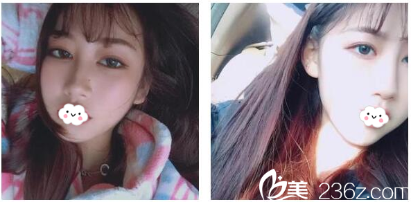 劉月更做的DD數(shù)碼雙眼皮1個月效果圖 劉月更做的DD數(shù)碼雙眼皮1個月效果圖