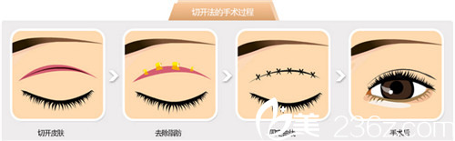 beautyline雙眼皮手術過程