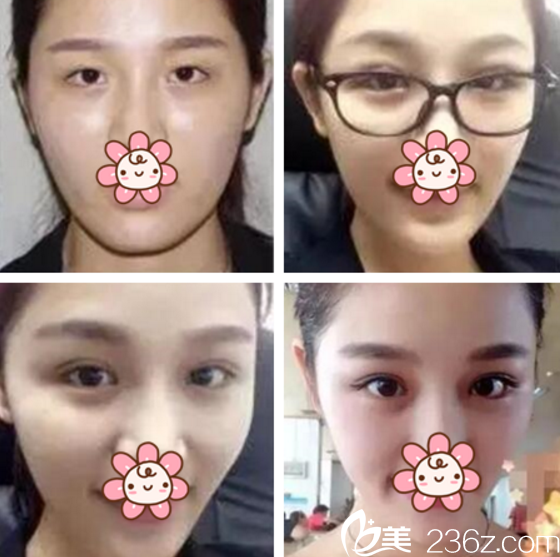 崔恒碩院長(zhǎng)眼修復(fù)案例 崔恒碩院長(zhǎng)眼修復(fù)案例