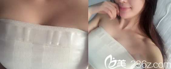 在合肥華美整形美容醫(yī)院做假體豐胸手術(shù)后第4天的樣子