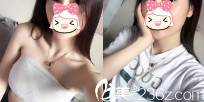 合肥華美整形美容醫(yī)院趙輯做假體隆胸術(shù)后第7天拆線前后照