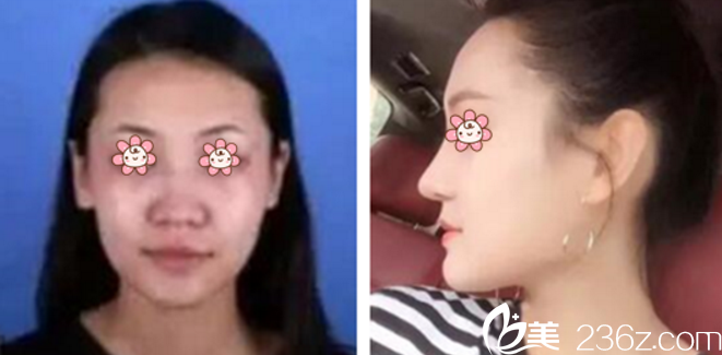 張裕珍院長隆鼻案例