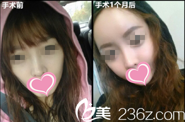 面部自體脂肪填充效果前后對比