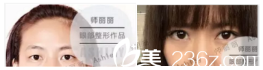 師麗麗醫(yī)生雙眼皮案例效果 師麗麗醫(yī)生雙眼皮案例效果