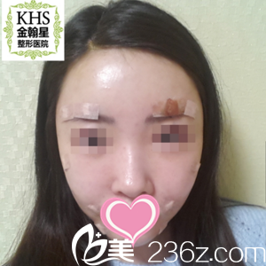 面部填充當(dāng)天效果