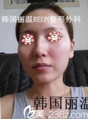去韓國麗溫REON整形面診前 去韓國麗溫REON整形面診前