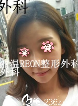 賊喜歡韓國麗溫REON整形樸庭逸給我做的顴骨縮小+下頜角肉肉小V臉