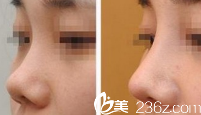 在蚌埠國色整形美容醫(yī)院做鼻子整形