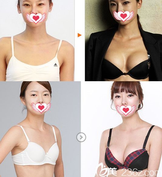 找蚌埠國色整形美容醫(yī)院做假體隆胸